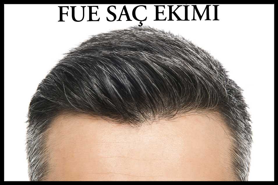 FUE Saç Ekimi Yöntemi ile Saçlarınız Artık Daha Dolgun