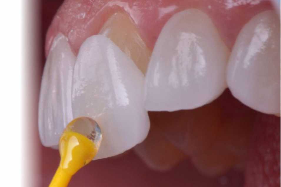 Ağız ve Diş Sağlığı İçin Günümüzde Diş Tedavileri