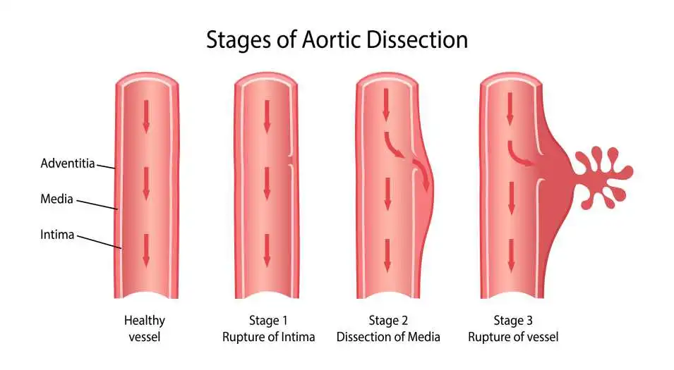 aort diseksiyonu (yırtılması) belirtileri ve tedavisi